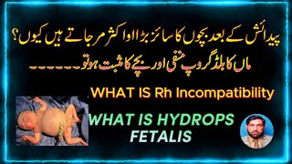 What is Hydrops Fetalis ماں کا بلڈ گروپ منفی ہو اور بچے کا مثبت ہو تو بچے پر کیا اثرات ہوتے ہیں۔ [upl. by Aniale]