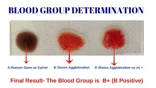 Blood Group Test  Procedure for Determination of Blood Group  Blood Group Determination Test [upl. by Skipton111]