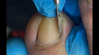 Huge ingrown toenail removal [upl. by Kcirdek818]