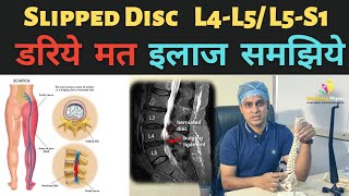 L4L5  L5S1 स्लिप डिस्क का इलाज  Slipped Disc Treatment Hindi  कमर के छल्ले सरकना क्या होता है [upl. by Kienan208]