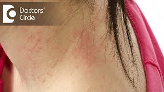 What does dry white itchy patch with redness indicateDr Rasya Dixit [upl. by Naman]