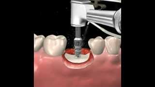 Step by step dental implant surgery Gary R OBrien DDS [upl. by Llerot]