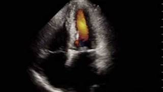 Mitral stenosis video with audible mid diastolic murmur [upl. by Naujtna]