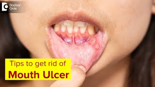 Mouth Ulcer Mouth Sores Symptoms Treatment amp Prevention MethodsDrLahari ASR  Doctors Circle [upl. by Beedon]