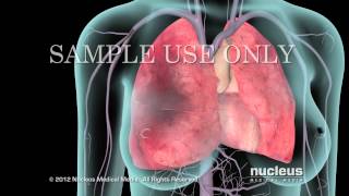 EMBOLIA PULMONAR – Causas Sintomas e Tratamento [upl. by Pearse256]