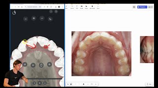 Case study №4 anterior crowding roundtripping  inoffice aligners [upl. by Narcissus304]