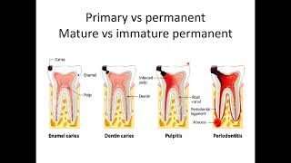 Management of deep carious lesion in primary teeth 4th year student JU [upl. by Kenti54]