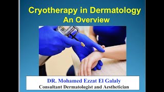 Cryotherapy in Dermatology [upl. by Namien977]