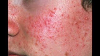 Acne Symptoms and Causes  Diagnosis  Treatment  Prevention [upl. by Dunlavy]