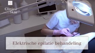 Elektrische epilatie behandeling [upl. by Hoopen132]