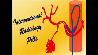 BismuthCorlette classification system for cholangiocarcinoma [upl. by Anahpets]