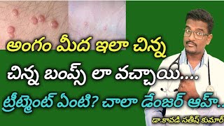 Molluscum Contagiosum Treatment In Telugu  Doctor Satheesh  Yes1TV Health [upl. by Aryk]