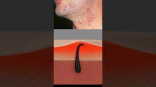 Stop Ingrown Hairs  The Root Cause Explained [upl. by Ylrebmek]