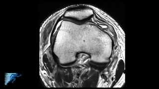 PLC Injury Knee MRI  Posterolateral Corner Knee Injury  Knee Pain Symptoms  Minneapolis MN [upl. by Lucien]