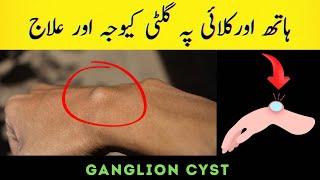 Ganglion cyst causes symptoms and treatment  Wrist ganglion cyst explained [upl. by Egide]