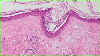 Lichen Sclerosus 🩺Treatment 🩺Symptoms 🩺Causes📰 [upl. by Nole70]