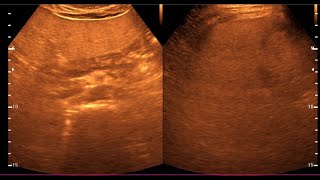 Fatty Liver  Diffuse hepatic steatosis  Liver Ultrasonogram [upl. by Emelda]