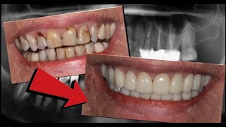 Full Mouth Rehabilitation with Zirconia crowns [upl. by Aimej]