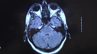 Patient Experiences 10 Minutes Of Brain Activity After Death [upl. by Anomahs592]