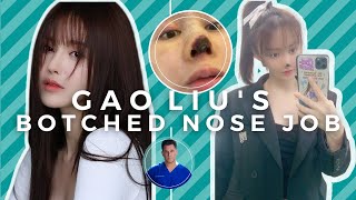 GAO LIUS BOTCHED NOSE JOB Tip Necrosis from Open Rhinoplasty [upl. by Nerrot766]