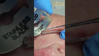 Under Eye Lesion Treatment [upl. by Esalb]