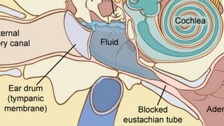 How to Treat Fluid in the Ear  Ear Problems [upl. by Cormier]