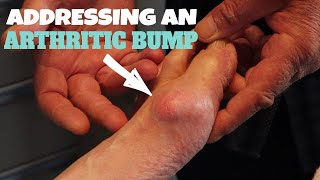 HOW TO ADDRESS AN ARTHRITIC BUMP [upl. by Kent]