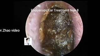 Ear Wax Removal [upl. by Reinertson]