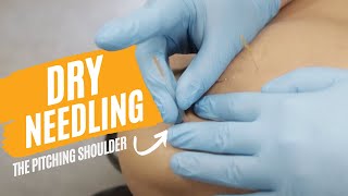 Shoulder Recovery  Dry Needling the Pitching Shoulder [upl. by Remsen]