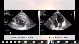 21 06 04 Echocardiogram interpretation [upl. by Irehc]