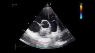 Diastolic flow in the pulmonary artery coronary fistula echo [upl. by Dallon]