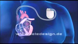 HGL 020 Schrittmacher Zweikammer  PAL 169 HGL 020 Biventricular pacemaker  PAL 169 [upl. by Kenta]