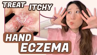 How to Treat Hand Eczema 🖐️ Dr Joyce Dermatologist [upl. by Pontus]