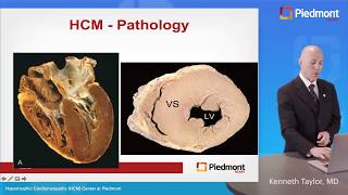 Hypertrophic Cardiomyopathy – Contemporary Approach to Diagnosis and Management [upl. by Bui903]