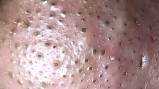 Blackheads amp Whiteheads Satisfying Removal 0004 [upl. by Eduard762]