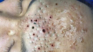 blackheads lipsl Acne treatment l Extraction cysts and blackheads l blackheads lips [upl. by Hermina]