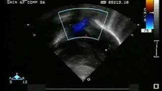 Type I Persistent Truncus Arteriosus [upl. by Anilev]