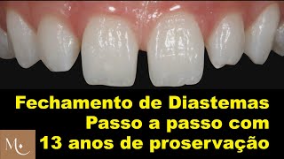 Faceta em Resina Composta  Técnica e Proservação [upl. by Ninette]