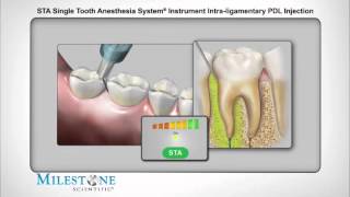 STAмодифицированая интралигаментарная анестезия [upl. by Amitie]