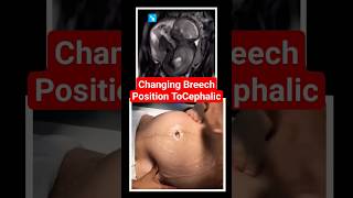 changing breech baby to cephalic position brechbaby babyultrasound babypositionpregnancy [upl. by Annairdna391]