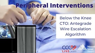 Below the Knee CTO Antegrade Wire Escalation Algorithm  February 28 2018 [upl. by Augustina]