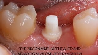 Zirconia Implant [upl. by Leziar]