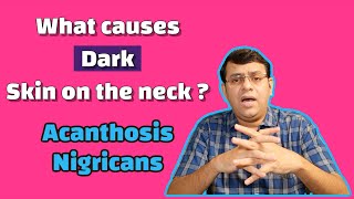 What causes dark skin on the neck   Acanthosis Nigricans [upl. by Adnwahsal]