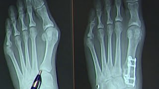 Healthcast New bunion surgery cuts recovery time [upl. by Aled447]