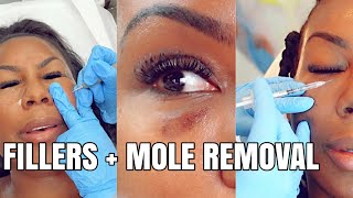 BLACK EYE DISSOLVING TEAR TROUGHS FILLER  LASER MOLE REMOVAL [upl. by Oiligriv]