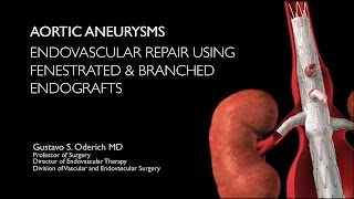 Aortic aneurysm treatment with endovascular fenestrated and branched stentgrafts [upl. by Nylirek]