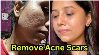 How to remove acne scars 😍  Acne scars remove treatment  My skin transformation journey [upl. by Refinneg]