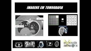 ESCALA DE HOUNSFIELD  HU  E FORMAÇÃO DA IMAGENS EM TOMOGRAFIA [upl. by Varipapa]