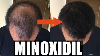 Hair loss solution  बाल उगाने की दवाई Minoxidil  hairloss  Dr Farzana  1mg [upl. by Elades]