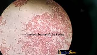 Wuchereria bancrofti in Urine [upl. by Lativa]